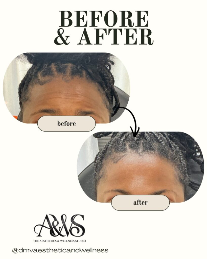 Before and after Daxxify wrinkle relaxer for forehead lines – The Aesthetics & Wellness Studio
