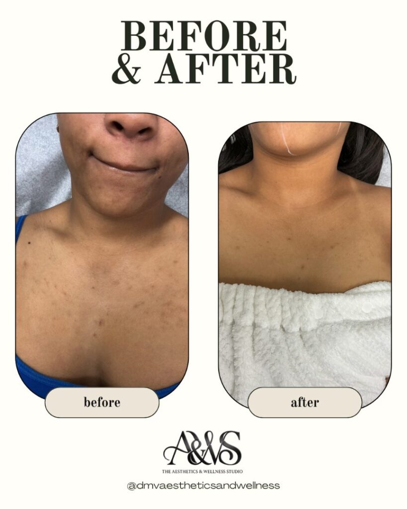 Before and after Aerolase laser treatment for hyperpigmentation on the chest – The Aesthetics & Wellness Studio, Upper Marlboro MD