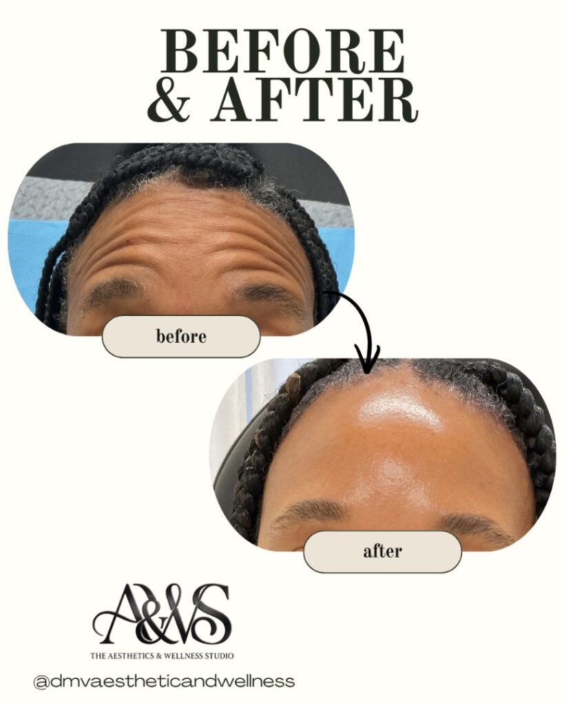 Before and after Daxxify wrinkle relaxer for deep forehead wrinkles – Upper Marlboro MD
