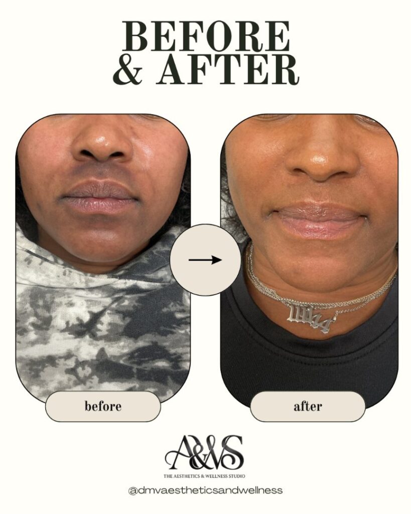 Before and after Aerolase laser treatment for hyperpigmentation around the mouth and chin – Upper Marlboro MD
