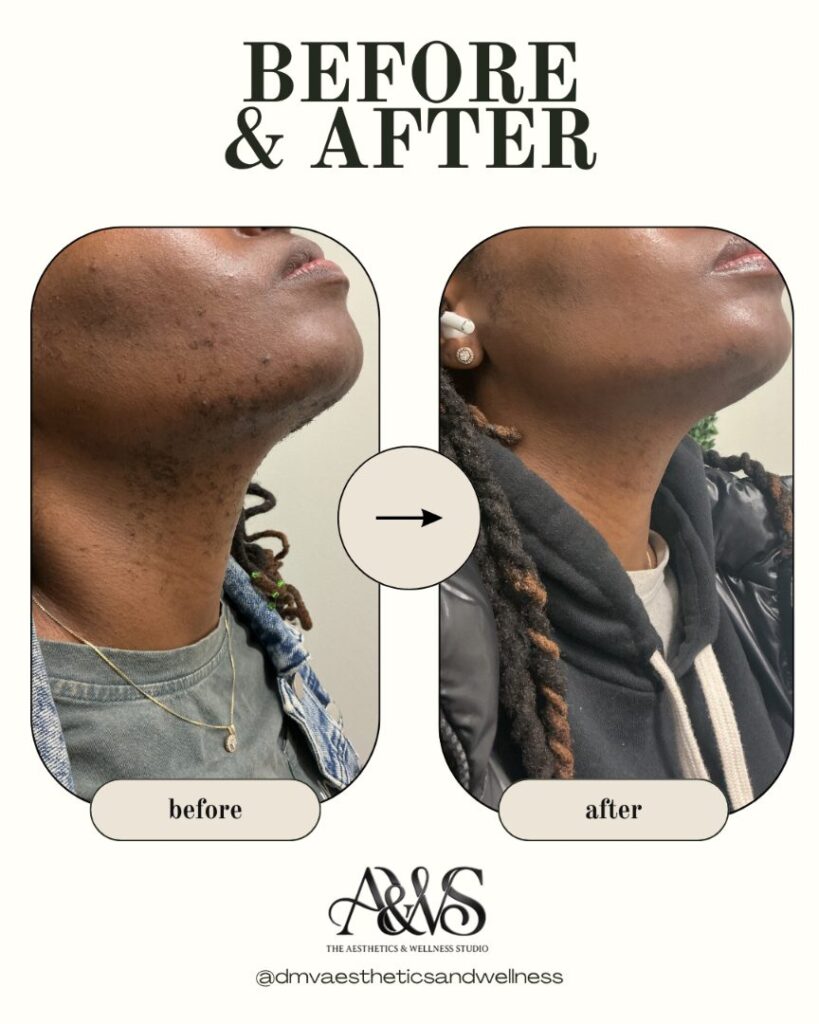 Before and after Aerolase laser hair removal and pigment correction for razor bumps on the neck – Upper Marlboro med spa
