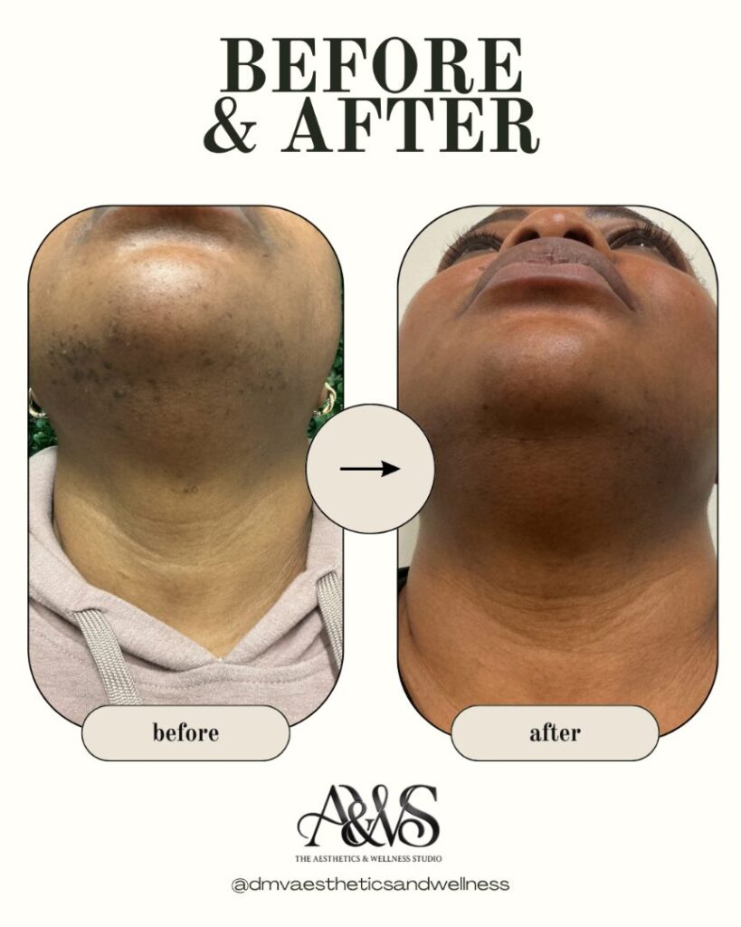 Before and after Aerolase laser hair removal and pigment correction under the chin – The Aesthetics & Wellness Studio