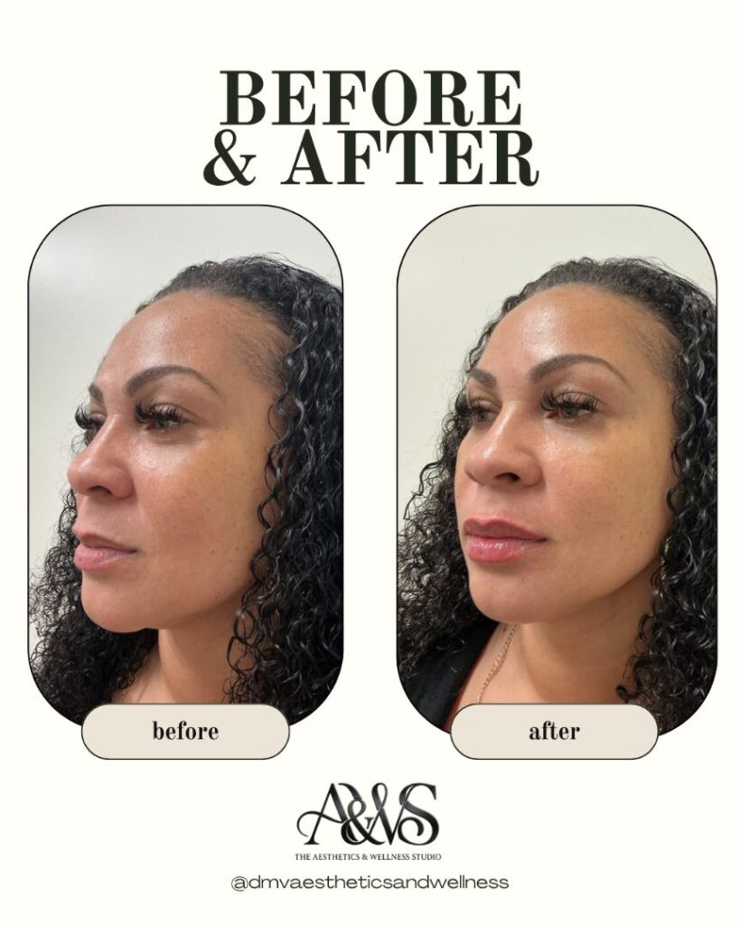 Before and after lip filler, profile view – The Aesthetics & Wellness Studio, Upper Marlboro MD
