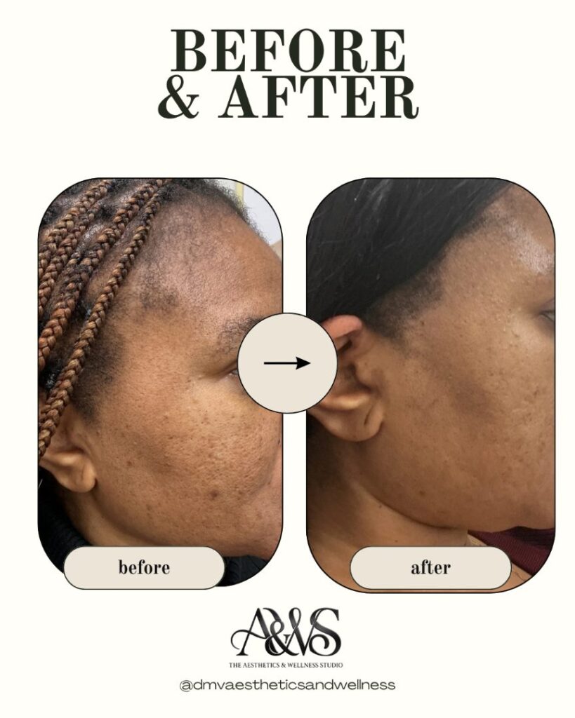 Before and after microneedling for acne scarring and skin texture – Upper Marlboro MD