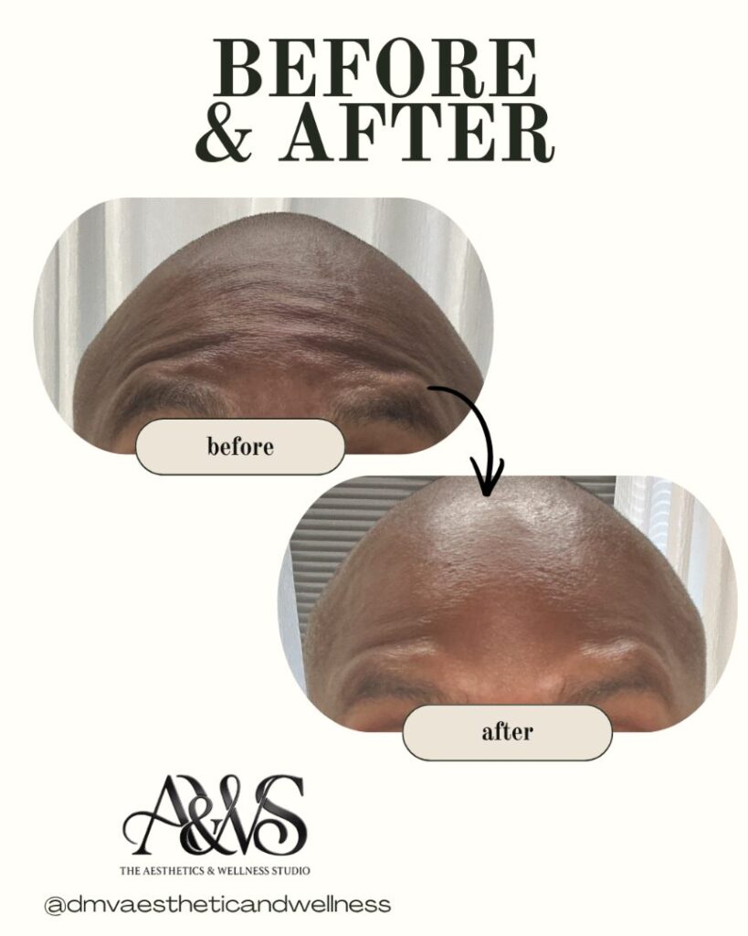Before and after Daxxify wrinkle relaxer for forehead wrinkles on a male client – Upper Marlboro med spa
