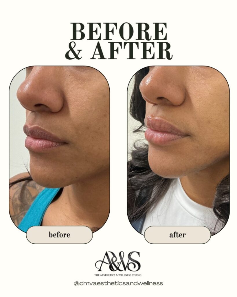 Before and after lip filler for natural-looking fuller lips – Upper Marlboro med spa