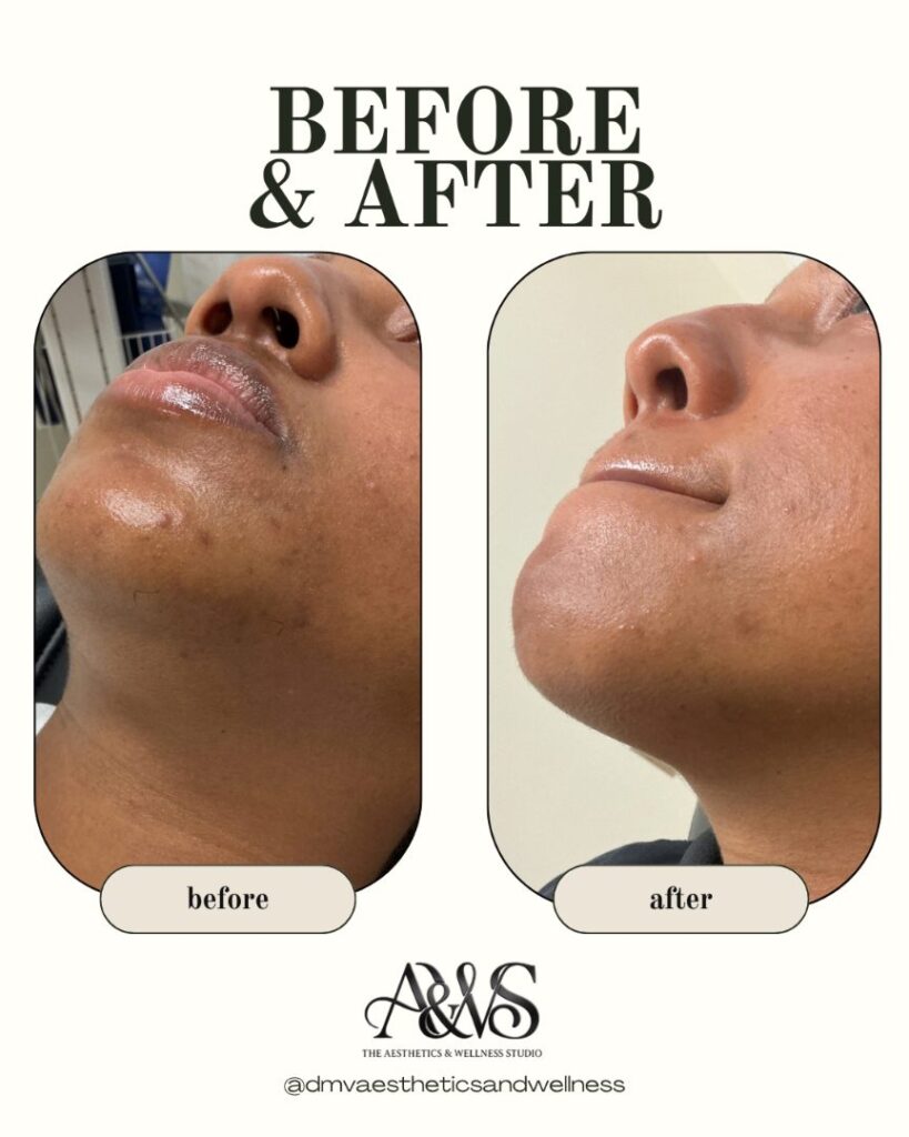Before and after Aerolase laser pigment correction for dark spots on the chin – The Aesthetics & Wellness Studio, Upper Marlboro MD