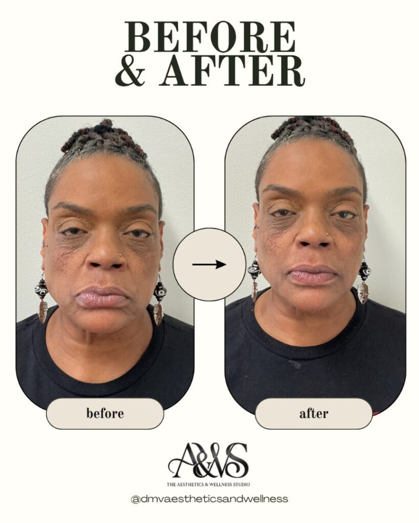 Before and after facial balancing – The Aesthetics & Wellness Studio, Upper Marlboro MD